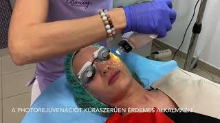 Bőrfiatalítás photorejuvenációval a Bársony Orvos-Esztétikában