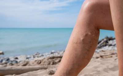 Nyáron nehezebb rejtegetni a visszereinket - itt az idő, hogy lépj!