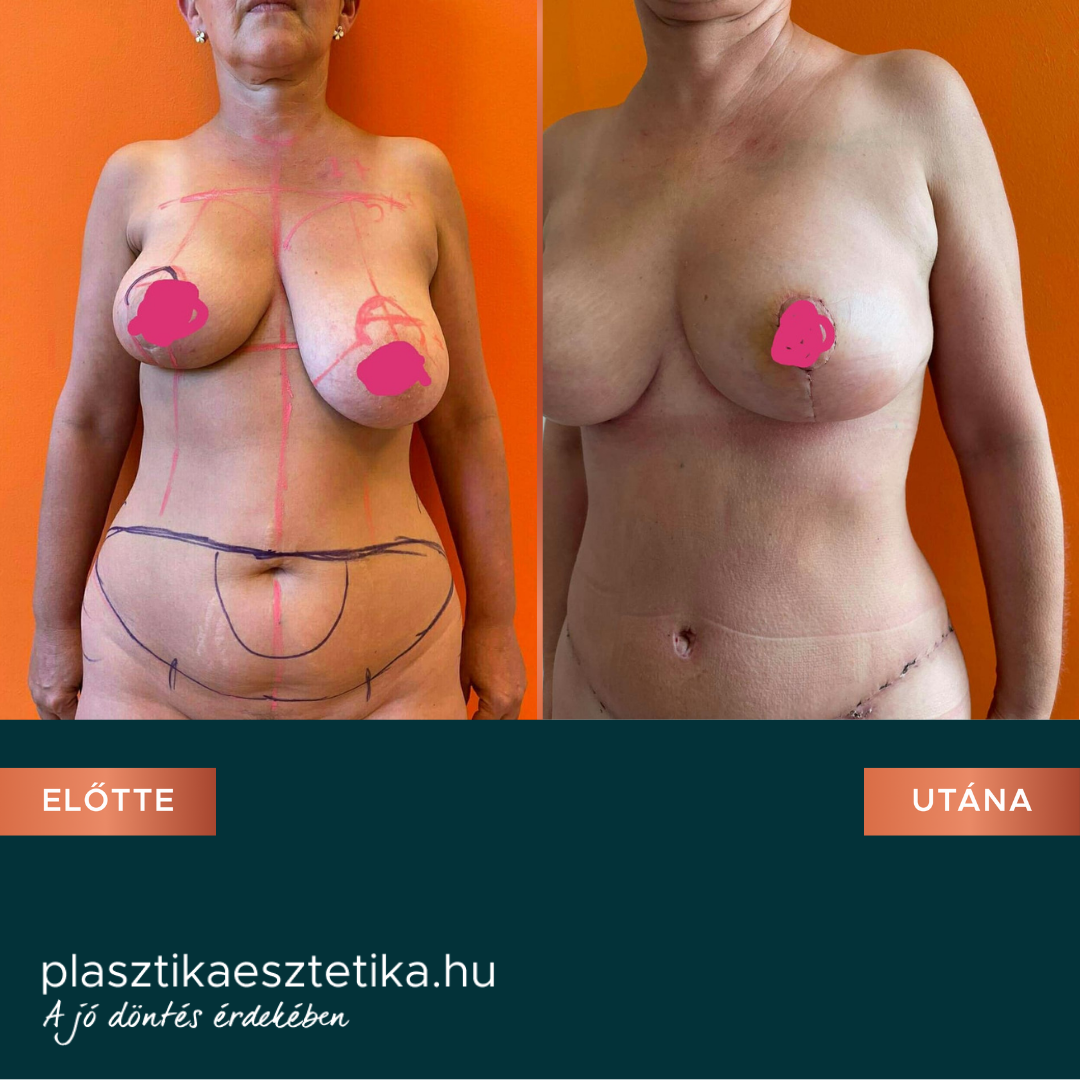 A műtét után, megváltozott az életem!