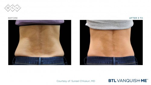 BEFORE & AFTER PHOTOS - The BTL Vanquish ME