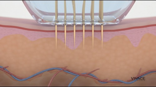 The Vivace Experience | Microneedling with Radio Frequency