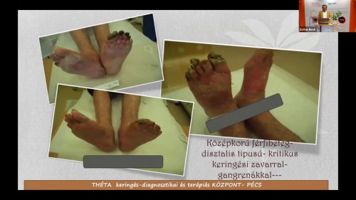 Webinár - Dr.Rozsos István érsebész