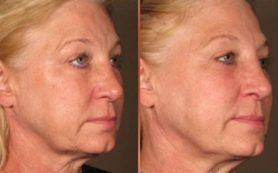 Hogyan lehet műtét nélkül feszesíteni a bőrt?