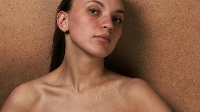 Hogyan segítsd a hegek gyógyulását varratszedés után?