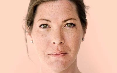 Kémiai hámlasztás vs. lézeres kezelés. Vajon melyik a megfelelő a Te bőrödnek?