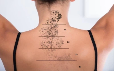 5 tény, amit mindenképp tudnod kell a lézeres tetoválás eltávolításról