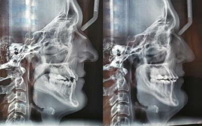 Orrplasztika: Ugyanúgy szerettem volna levegőt venni, mint mindenki más - Dávid története