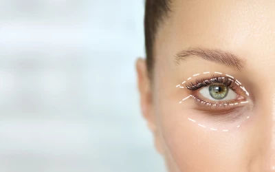 Ezért nem lett tökéletes a szemhéjplasztikám - egy páciens története I. rész