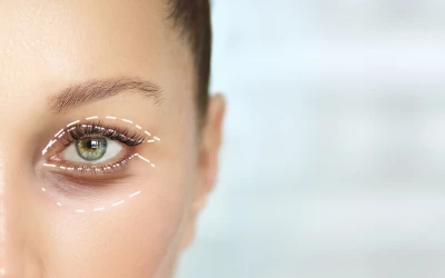 Ezért nem lett tökéletes a szemhéjplasztikám - egy páciens története II. rész